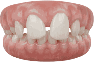 Gaps Between Teeth